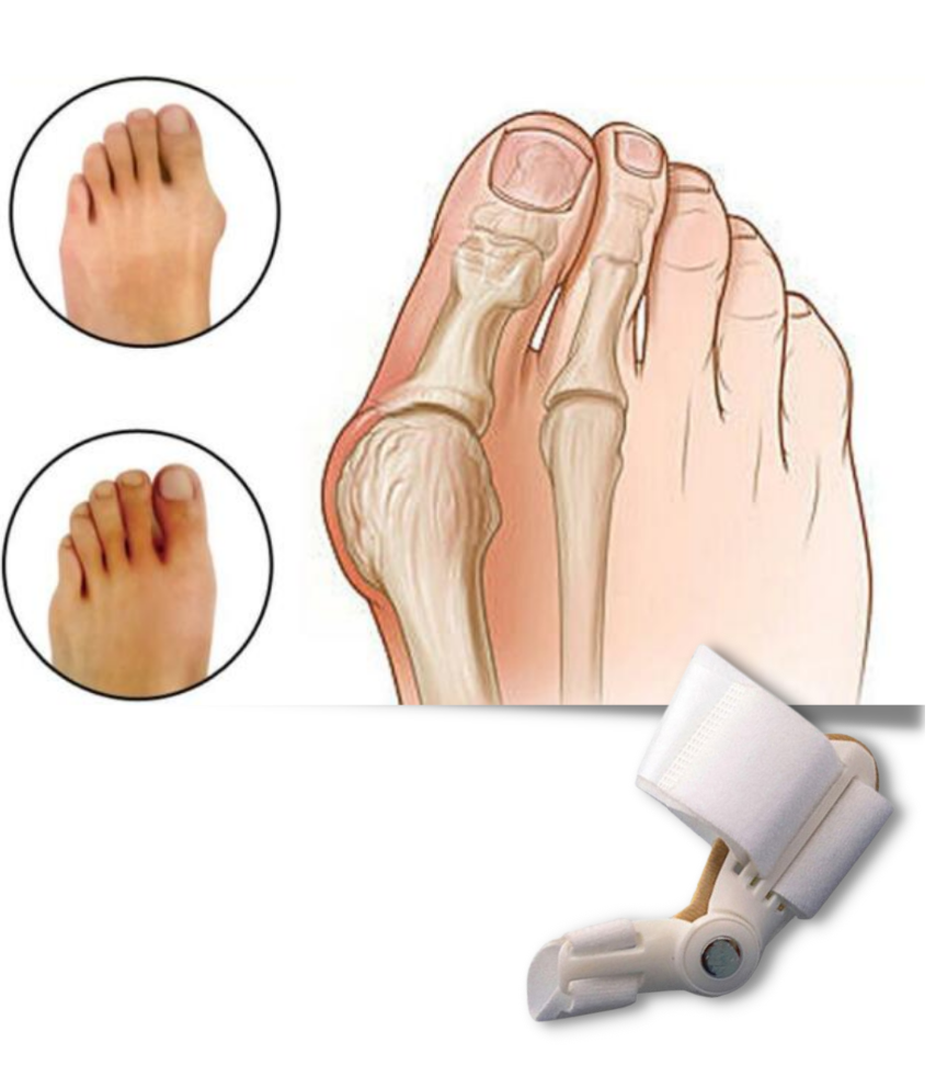 Orthopaedic Toe Bunion Corrector Pain Relief Day and Night Splinter