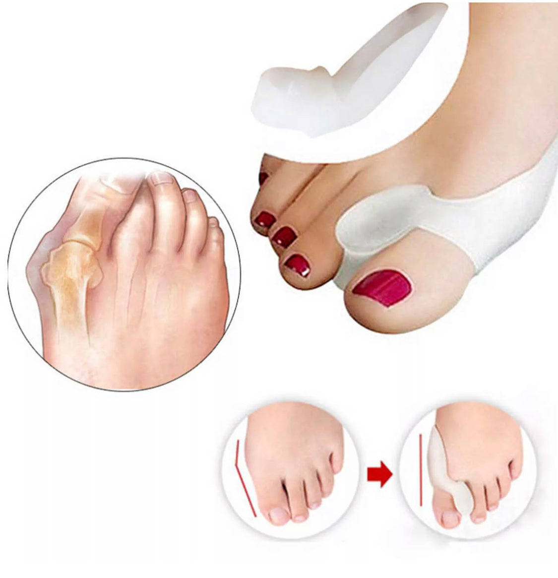 Orthopaedic Gel Toe Bunion Corrector Pain Relief Day and Night Splinter